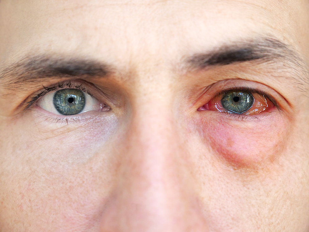 Close-up of a man's face showing one healthy eye and one eye with redness and swelling, illustrating symptoms of an eye infection, relevant to eye care and specialist consultation.