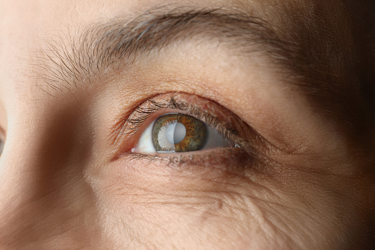 What are the symptoms of having cataracts