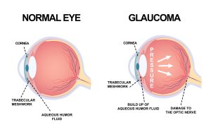 Glaucoma Sight Loss: Is It Reversible?