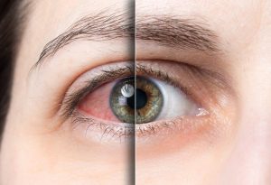 What Are the Symptoms of Glaucoma in Early Age