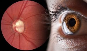 Early Warning Signs of Glaucoma